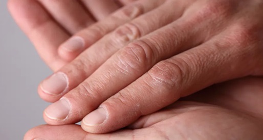 指甲变化可能揭示隐藏的肝脏健康问题